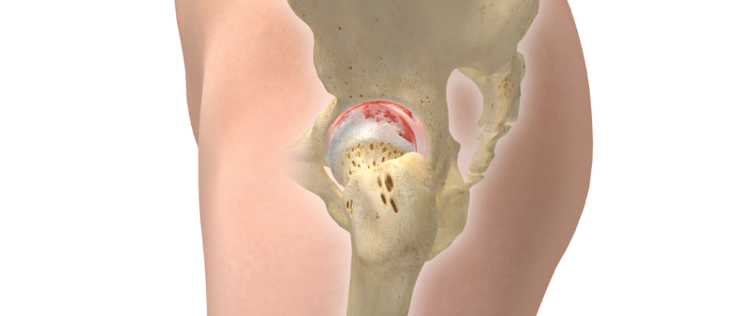 Hip Lateral Skeletal Arthritis Flat Copy